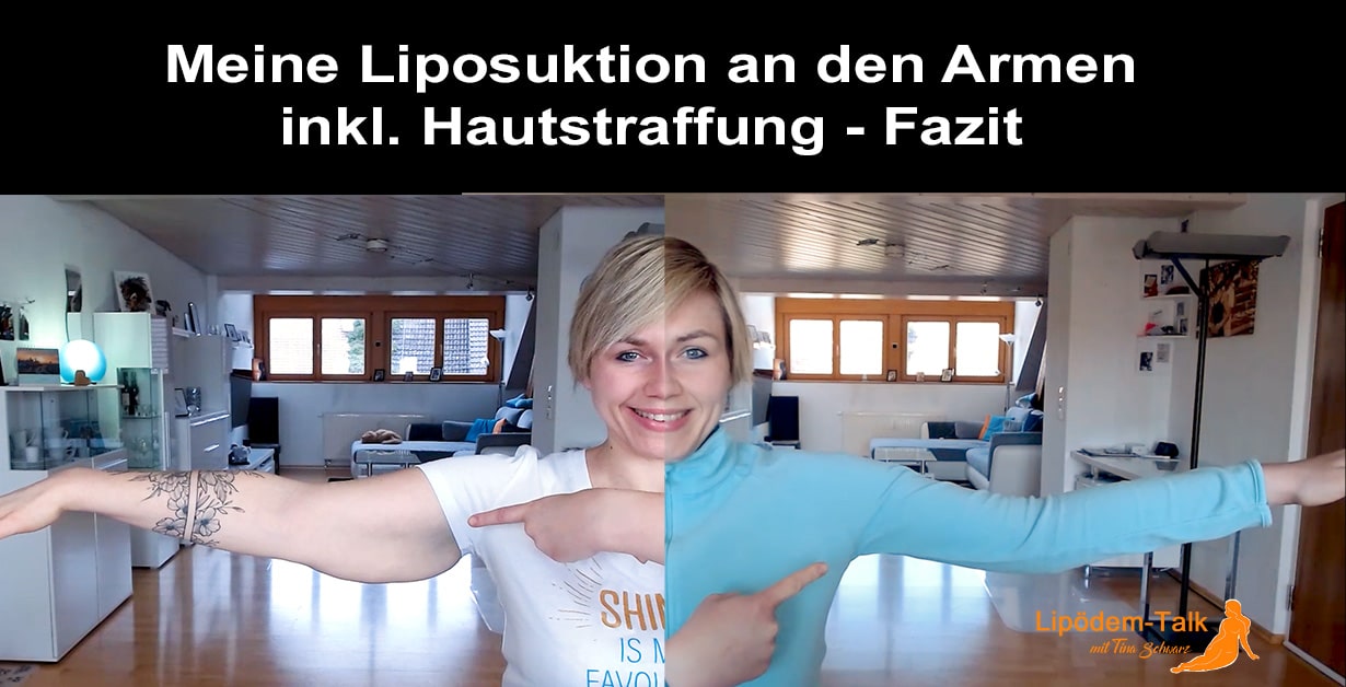 Meine Liposuktion an den Armen inkl. chirurgischer Hautstraffung